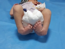 clubfoot overview and treatment options