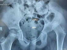 developmental displacement of the hip treatment