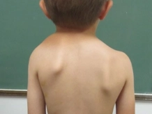 sprengel's shoulder congenital deformity