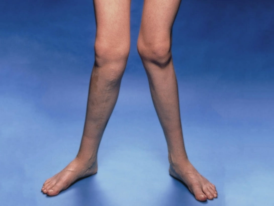 knock-knees-treatment-near-banajarjills